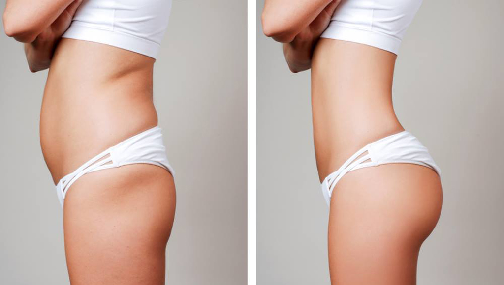liposuction before and after buttocks